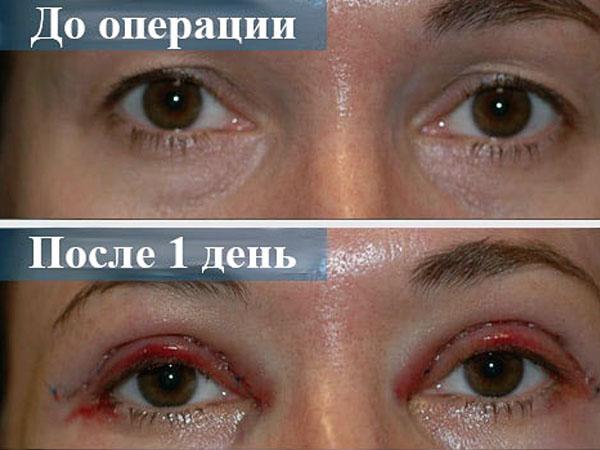 Как удаляют кожу с век глаз