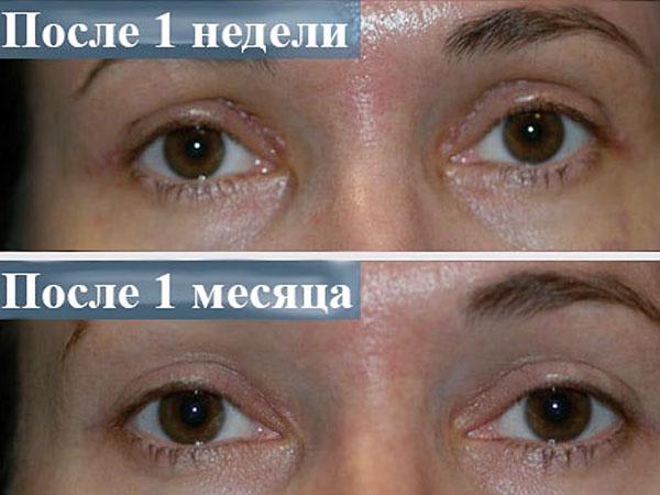Как удаляют кожу с век глаз