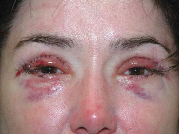 Кожа глаз после блефаропластики