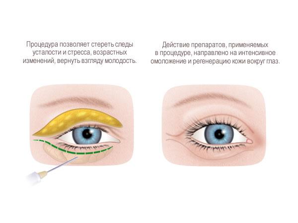 Инъекции для удаления грыжи глаза