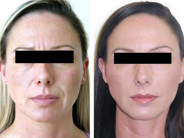 Что такое армирование кожи лица до и после