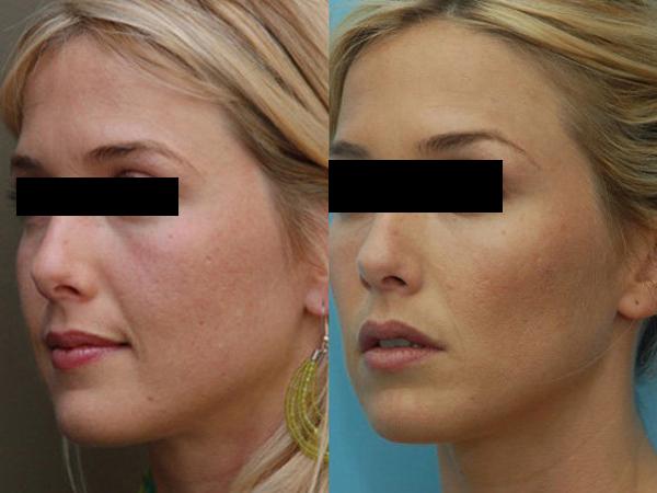 Введение плазмы в кожу лица