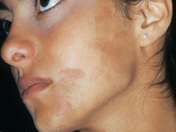 Уколы для отбеливания кожи лица