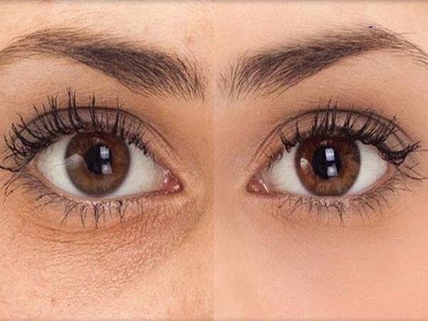 Dermaheal eyebag solution препарат для омоложения кожи вокруг глаз