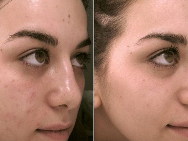Как очистить кожу лица с помощью перекиси водорода thumbnail