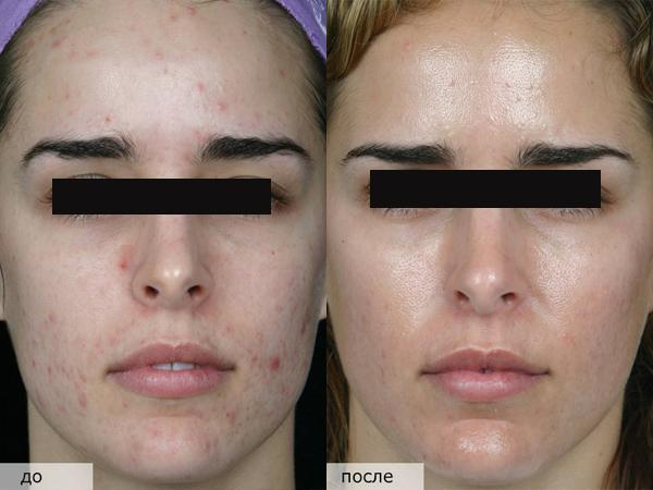 Обработка кожи лица азотом