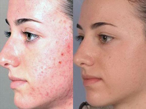 Очищение кожи лица косметологом