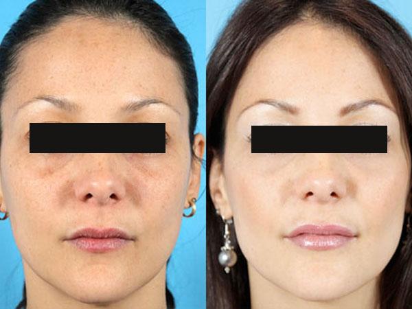 Очищение кожи лица косметологом