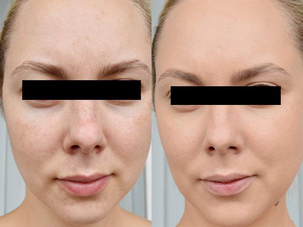 Ультразвуковая чистка лица для сухой кожи
