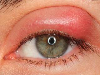Кожа глаз после блефаропластики