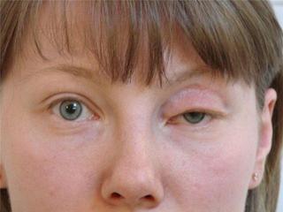 Кожа глаз после блефаропластики thumbnail