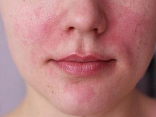 Инъекции для отбеливания кожи лица