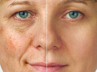 Инъекции для отбеливания кожи лица