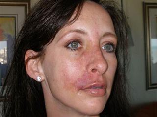 кожа на лице после операции