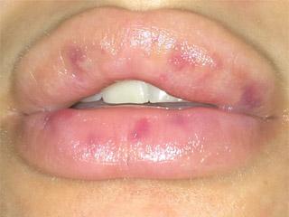 Мелкая сыпь после увеличения губ