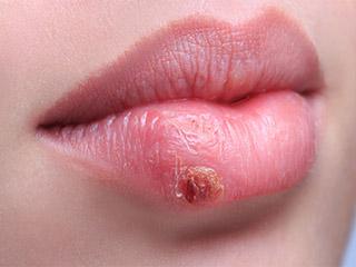 Мелкая сыпь после увеличения губ