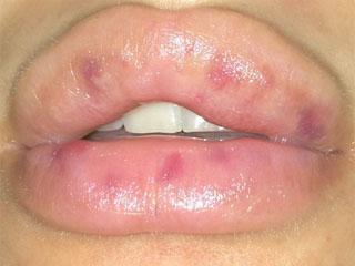 Отек и ассиметрия губ после увеличения