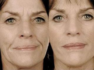 Массаж кожи лица после 40 лет