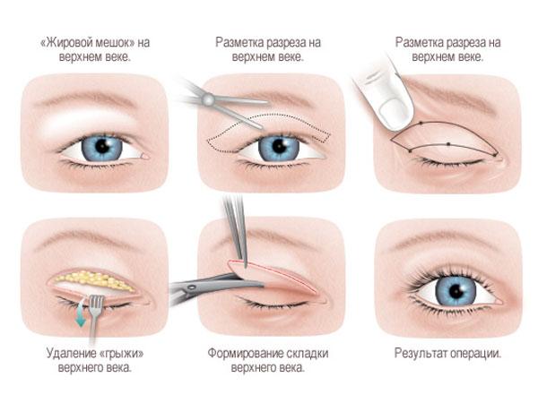 Сколько стоит убрать лишнюю кожу с век глаз