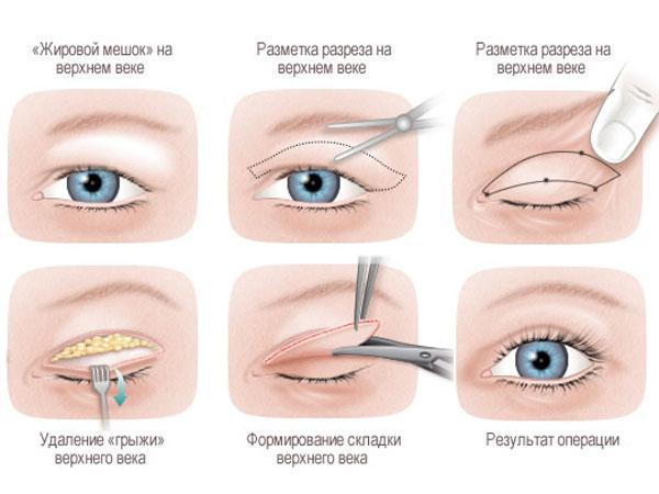 Фото после блефаропластики по дням