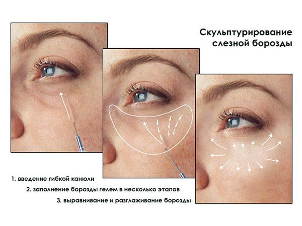 Контурная пластика кожи вокруг глаз