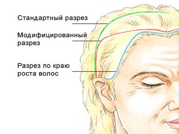 Височная подтяжка лба и бровей