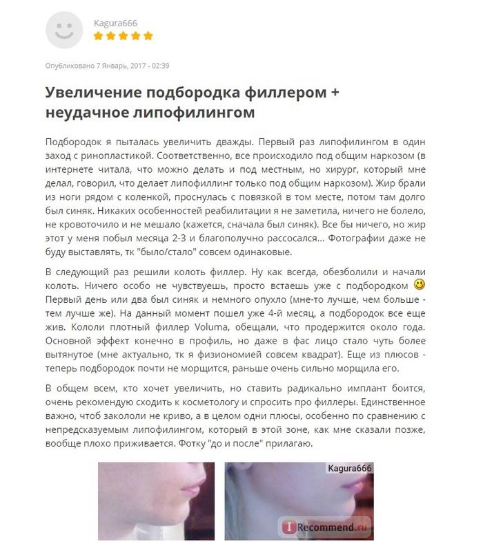 филлер для подбородка какой лучше. 212 2841. филлер для подбородка какой лучше фото. филлер для подбородка какой лучше-212 2841. картинка филлер для подбородка какой лучше. картинка 212 2841