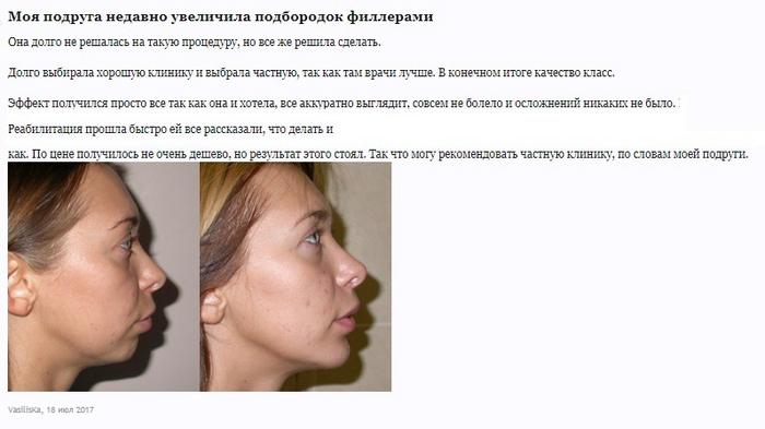 филлер для подбородка какой лучше. 212 2842. филлер для подбородка какой лучше фото. филлер для подбородка какой лучше-212 2842. картинка филлер для подбородка какой лучше. картинка 212 2842