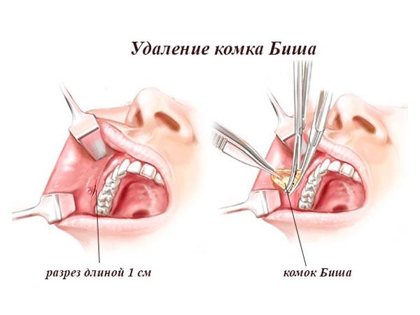 Мешочки бишопа что это. Смотреть фото Мешочки бишопа что это. Смотреть картинку Мешочки бишопа что это. Картинка про Мешочки бишопа что это. Фото Мешочки бишопа что это