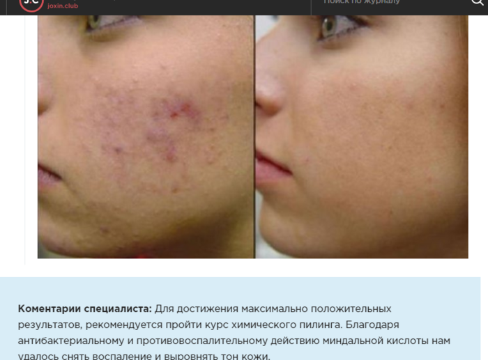 Как сделать дома миндальный пилинг. Смотреть фото Как сделать дома миндальный пилинг. Смотреть картинку Как сделать дома миндальный пилинг. Картинка про Как сделать дома миндальный пилинг. Фото Как сделать дома миндальный пилинг